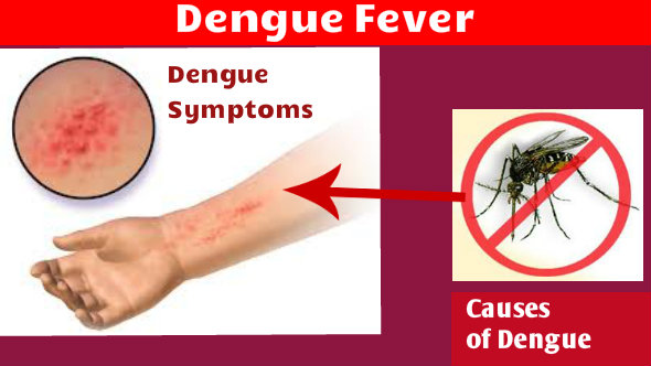 Dengue Symptoms 