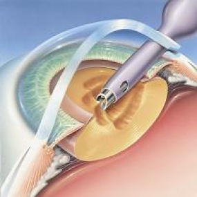 Cataract removal project in Puttalam