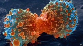 Most cancer types &#039;just bad luck&#039;