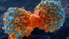 Most cancer types 'just bad luck'
